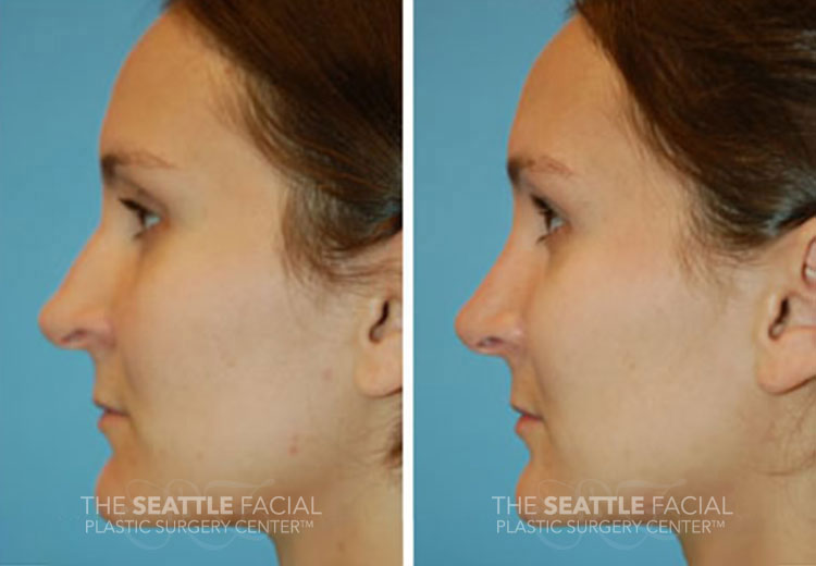 bulbous nasal tip