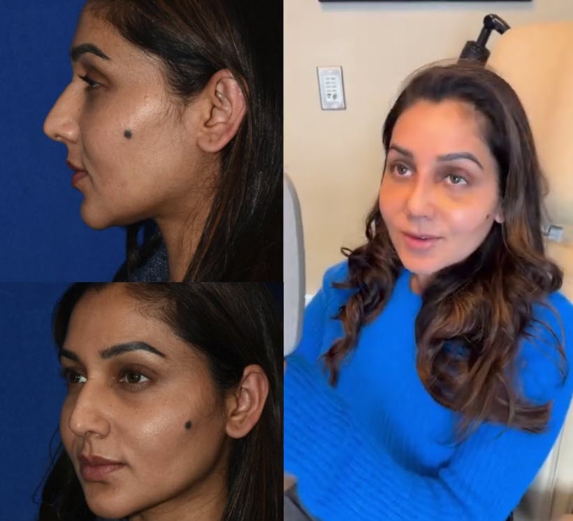 deviated septum surgery