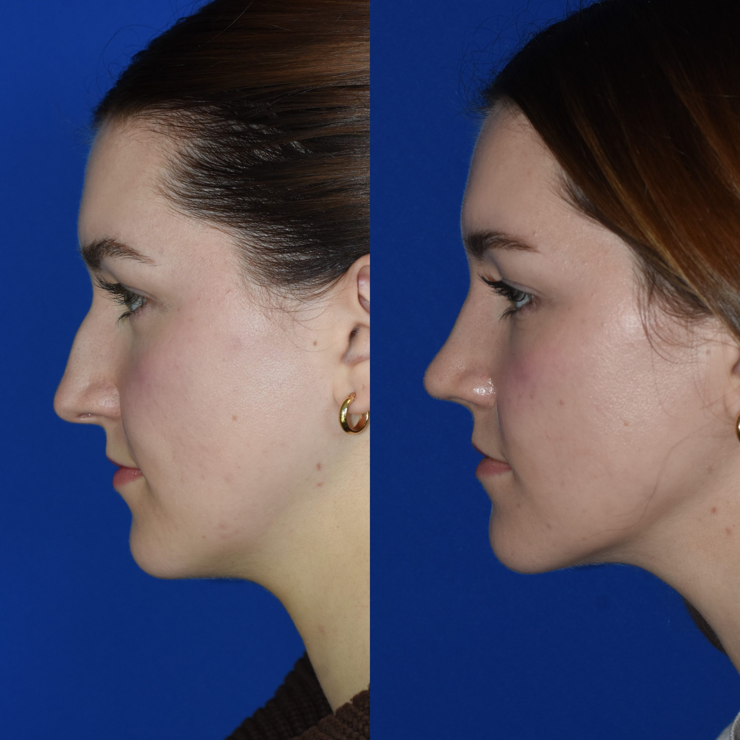 rhinoplasty surgery