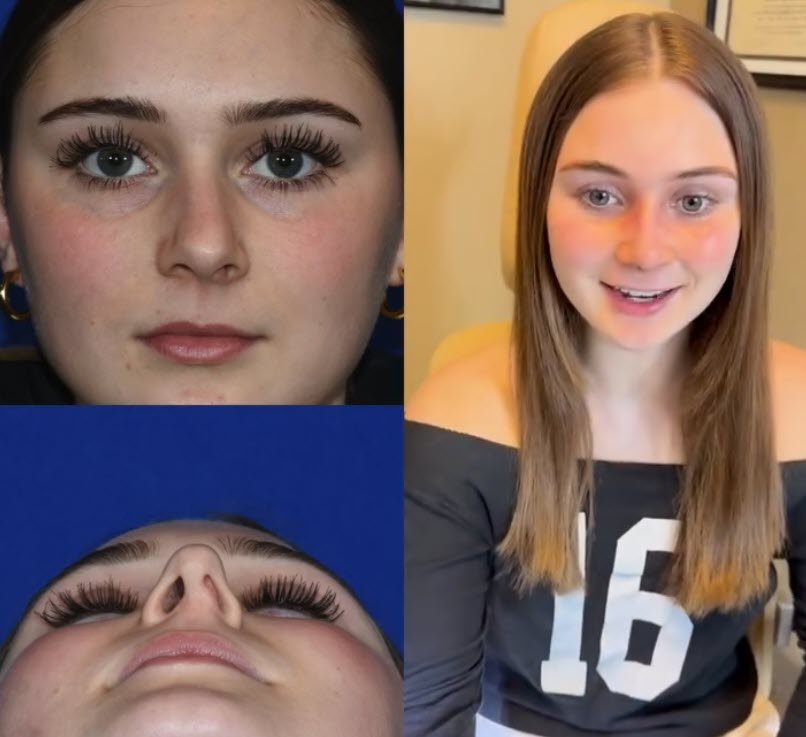 septorhinoplasty