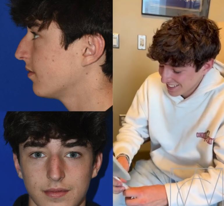 teen rhinoplasty surgery